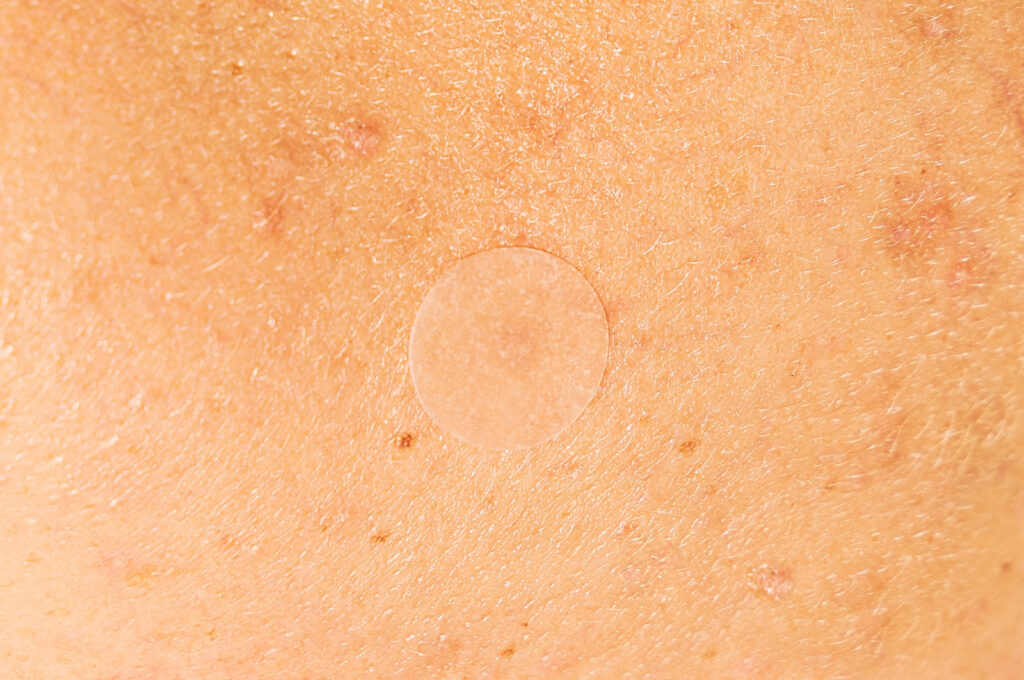 pickel rötungen wegbekommen